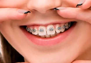 Ortodoncia fija